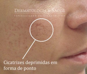 cicatrizes de acne