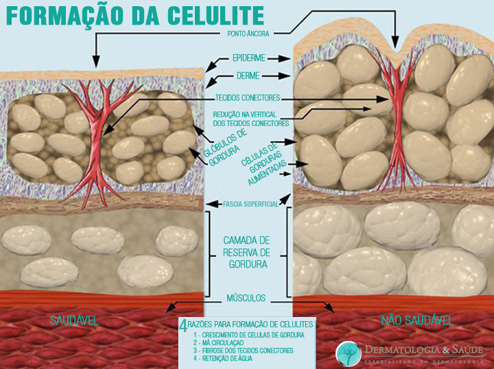 formacao-da-celulite-dermatologia-e-saude