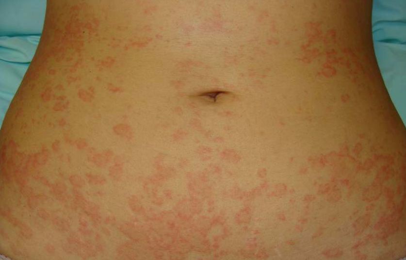 Pityriasis rosea - Better Health Channel