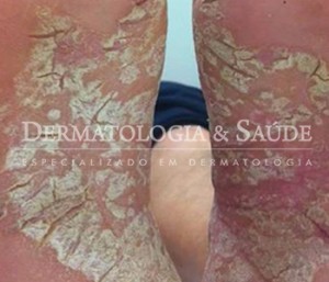 Psoríase Dermatologia e Saude