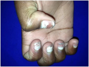 Manchas brancas nas unhas Manchas brancas nas unhas (1)