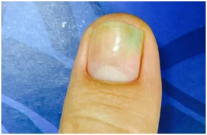 Manchas brancas nas unha Manchas brancas nas unha