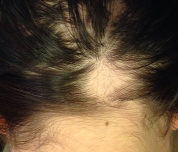 alopecia-areata-dermatologia-e-saude-350x300-02