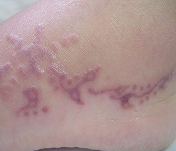 Dermatite de contato causada pela henna usada em tatuagem