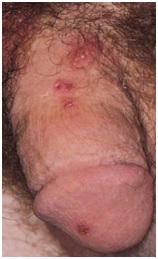 HSV 2 - Herpes Genital
