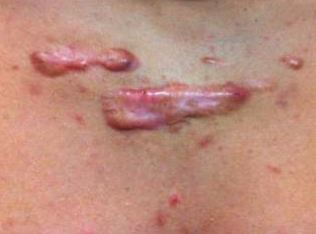 Queloide no tórax de adolescente, causado por acne