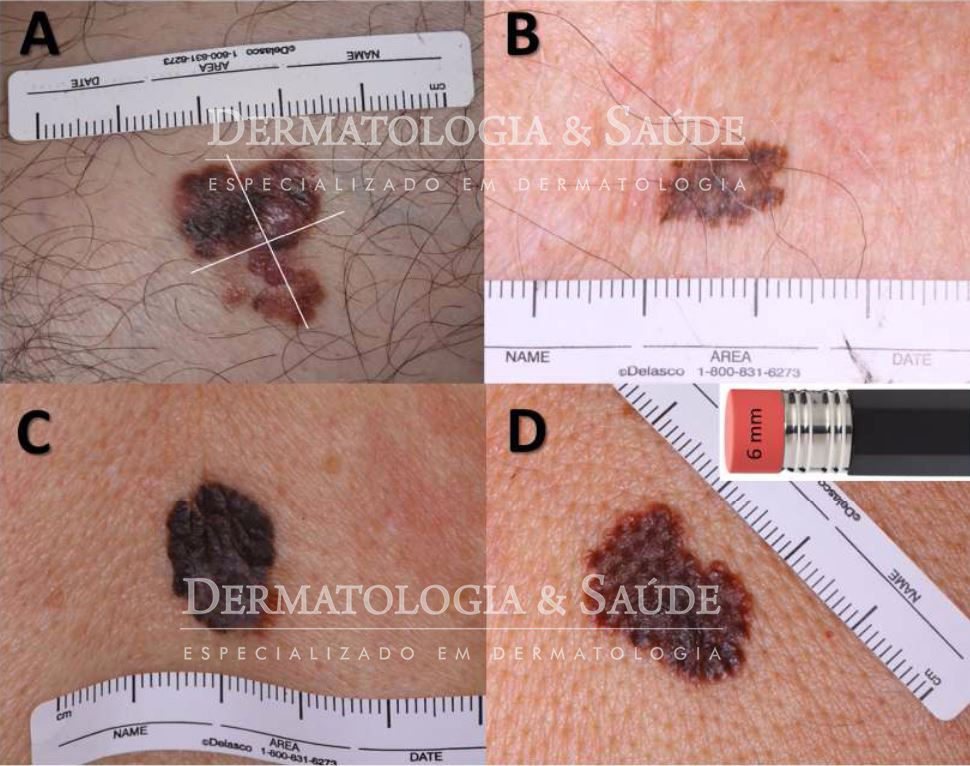 Melanoma regra do ABCD diagnostico de melanoma cancer de pele dermatologia e saude
