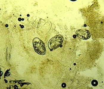 Ovos do ácaro causador da sarna, dentro de escama de raspado da pele