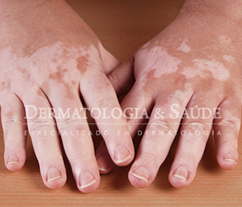 Vitiligo – É muito importante iniciar o tratamento sempre que possível no início, logo após o surgimento das lesões