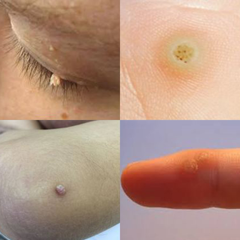 Imagens 1,2,3 e 4 – Verrugas virais (HPV) em diferentes localizações. Note que o aspecto da verruga é diferente dependendo da sua localização