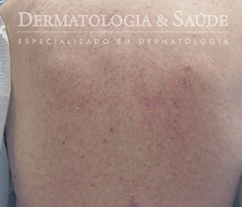 notalgia-parestesica-dermatologia-e-saude-350x300-2