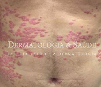 psoriase-dermatologia-e-saude-350x300-4
