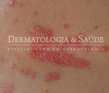 psoriase-dermatologia-e-saude-350x300-5