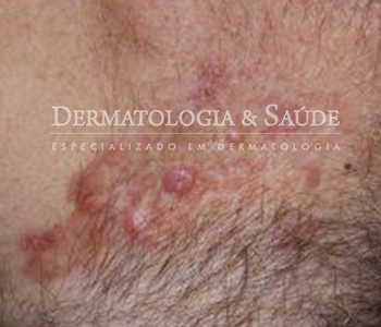 Dermatofibrosarcoma-Protuberans-dermatologia-e-saude-350x300-11