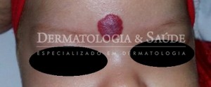 Hemangiomas-Infantis-dermatologia-e-saude-4