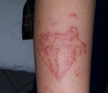 alergia-a-tatuagem-dermatologia-e-saude-01