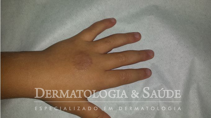 mão de criança com placa eritematosa anular de granuloma anular