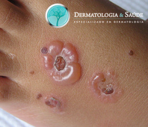 Dermatose-por-IgA-linear-dermatologia-e-saude-1