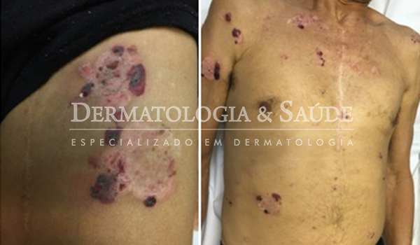 penfigo-dermatologia-e-saude-3