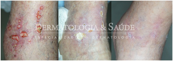 ulcera-de-perna-ulcera-de-estase-dermatologia-e-saude-2