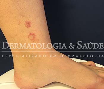 manchas-vermelhas-nas-pernas-o-que-pode-ser-dermatologia-e-saude