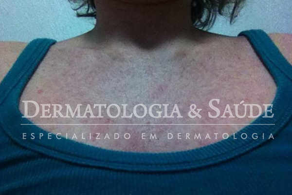 Lesões na pele de uma paciente com Zika