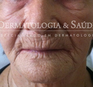 paciente com envelhecimento intenso da pele