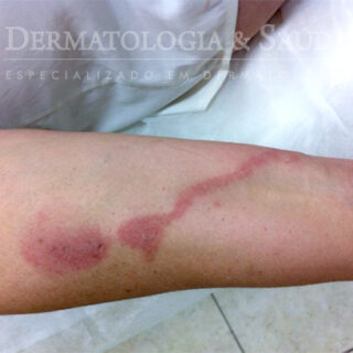 lesões eritêmato edematosas em braço D produzidas em um acidente por potó.