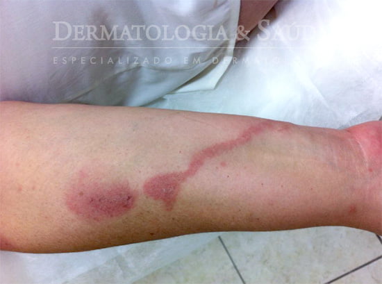 lesões eritêmato edematosas em braço D produzidas em um acidente por potó.