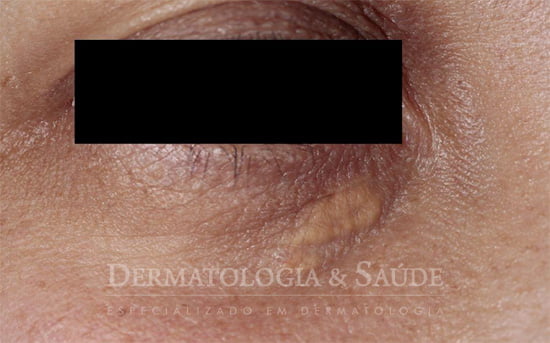 Xantelasma