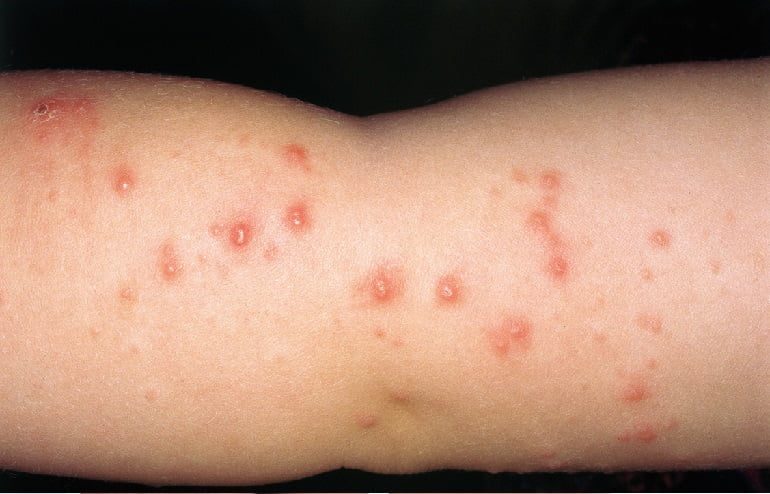Dermatite Herpetiforme