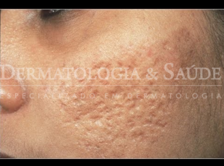 Cicatrizes de acne