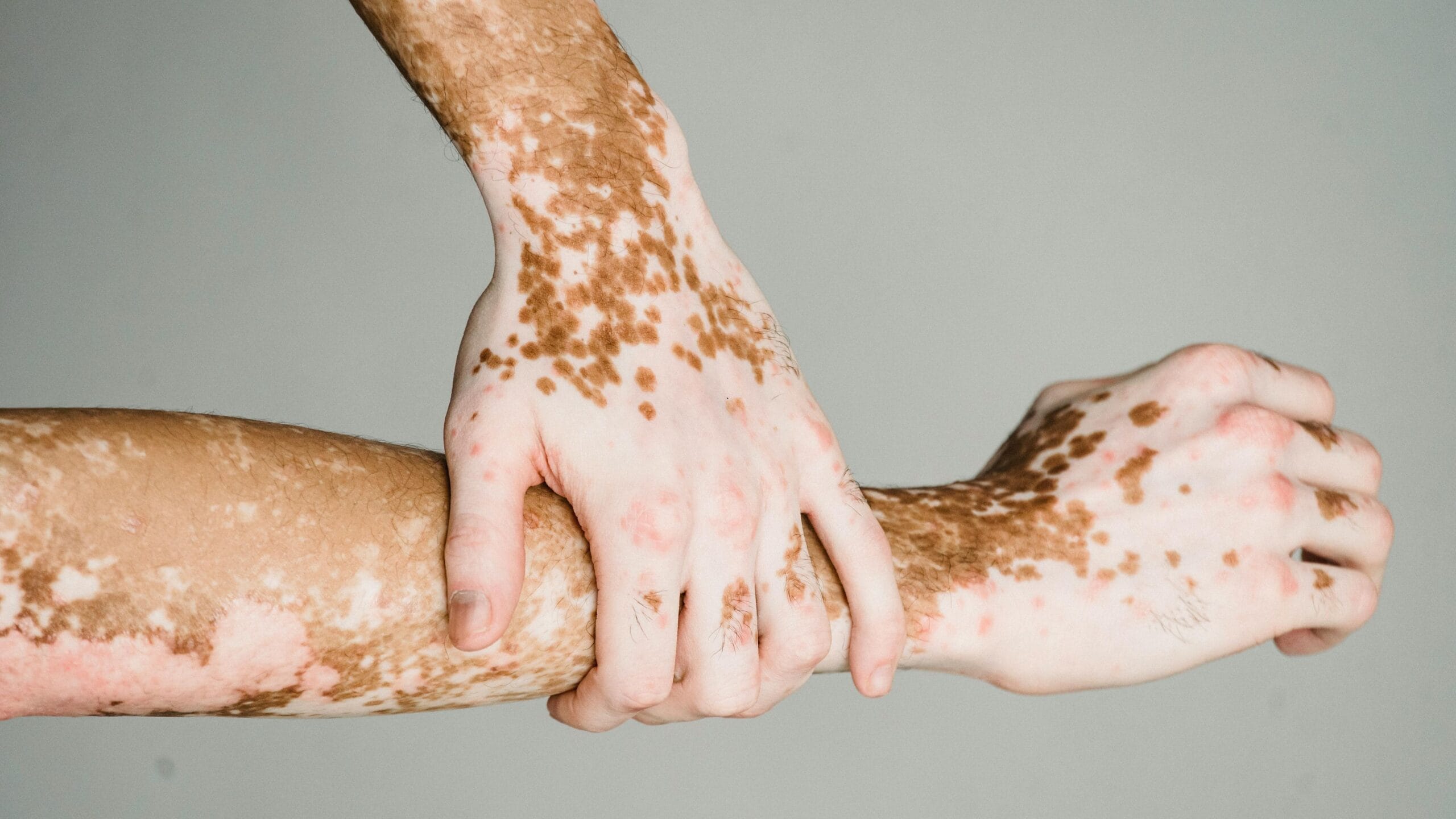 tipos de manchas brancas na pele e suas causas