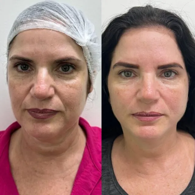 antes e depois lifintg Natal RN