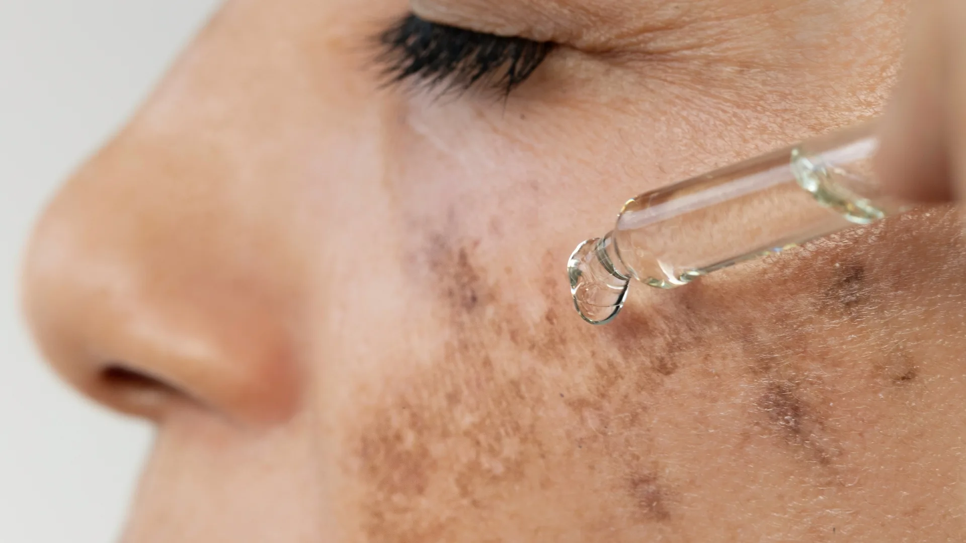 mulher com melasma realizando cuidados com a pele durante o inverno