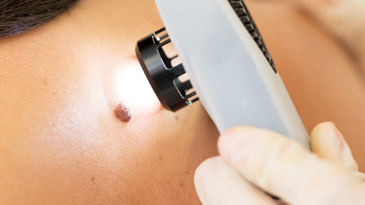 avaliação dermatológica de pinta suspeita para investigação de sinais de melanoma