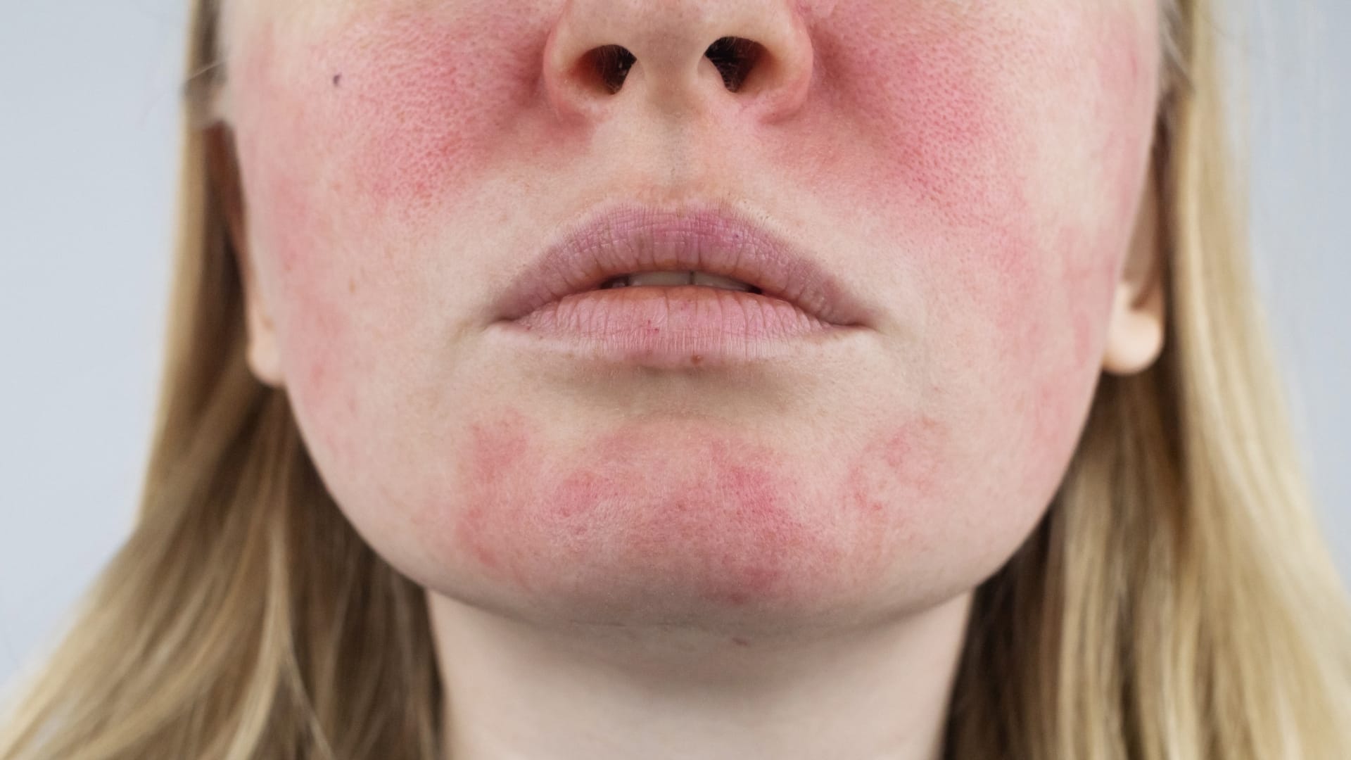 Dermatologista avaliando paciente com vermelhidão facial causada por rosácea.