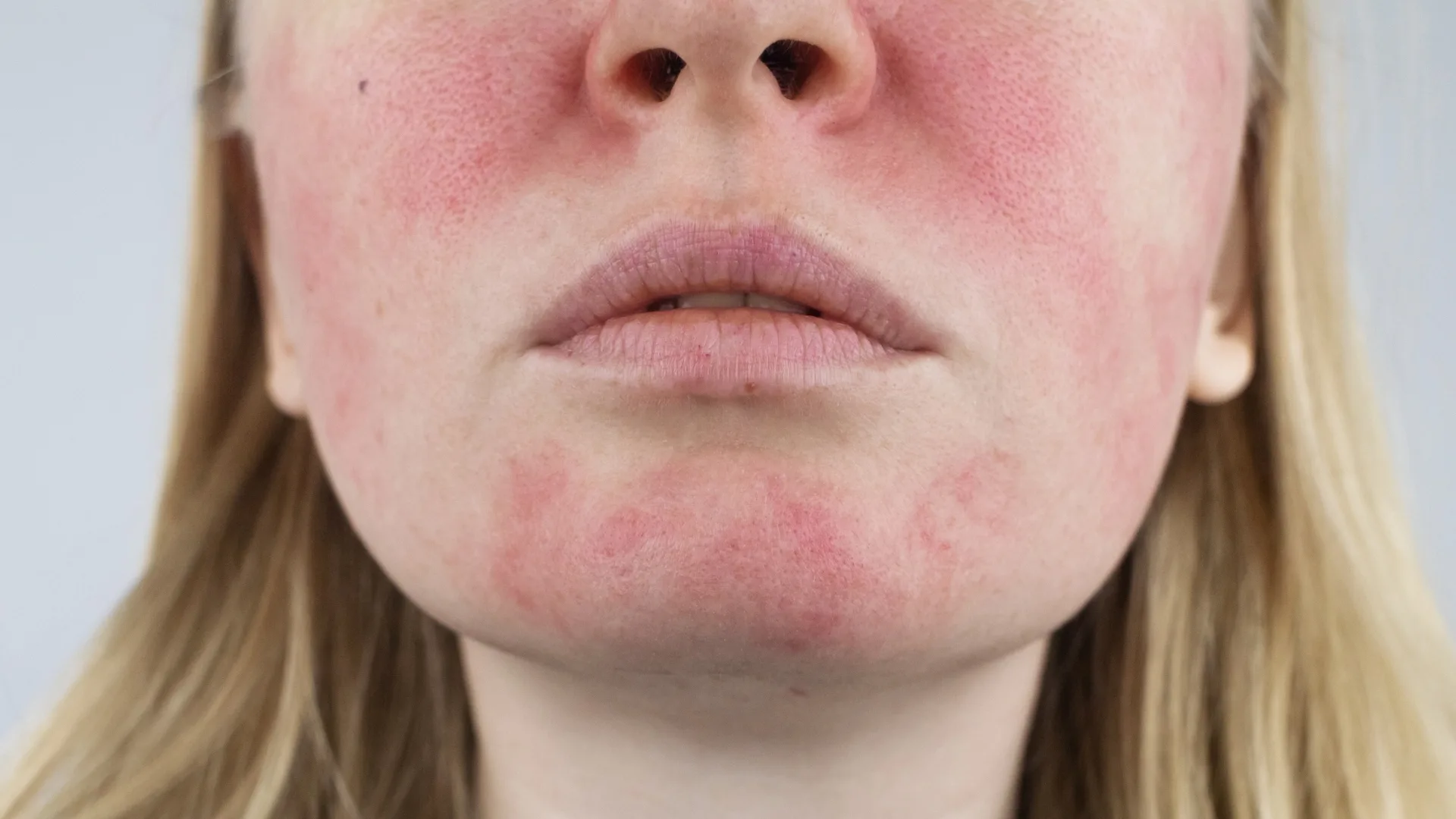 Dermatologista avaliando paciente com vermelhidão facial causada por rosácea.