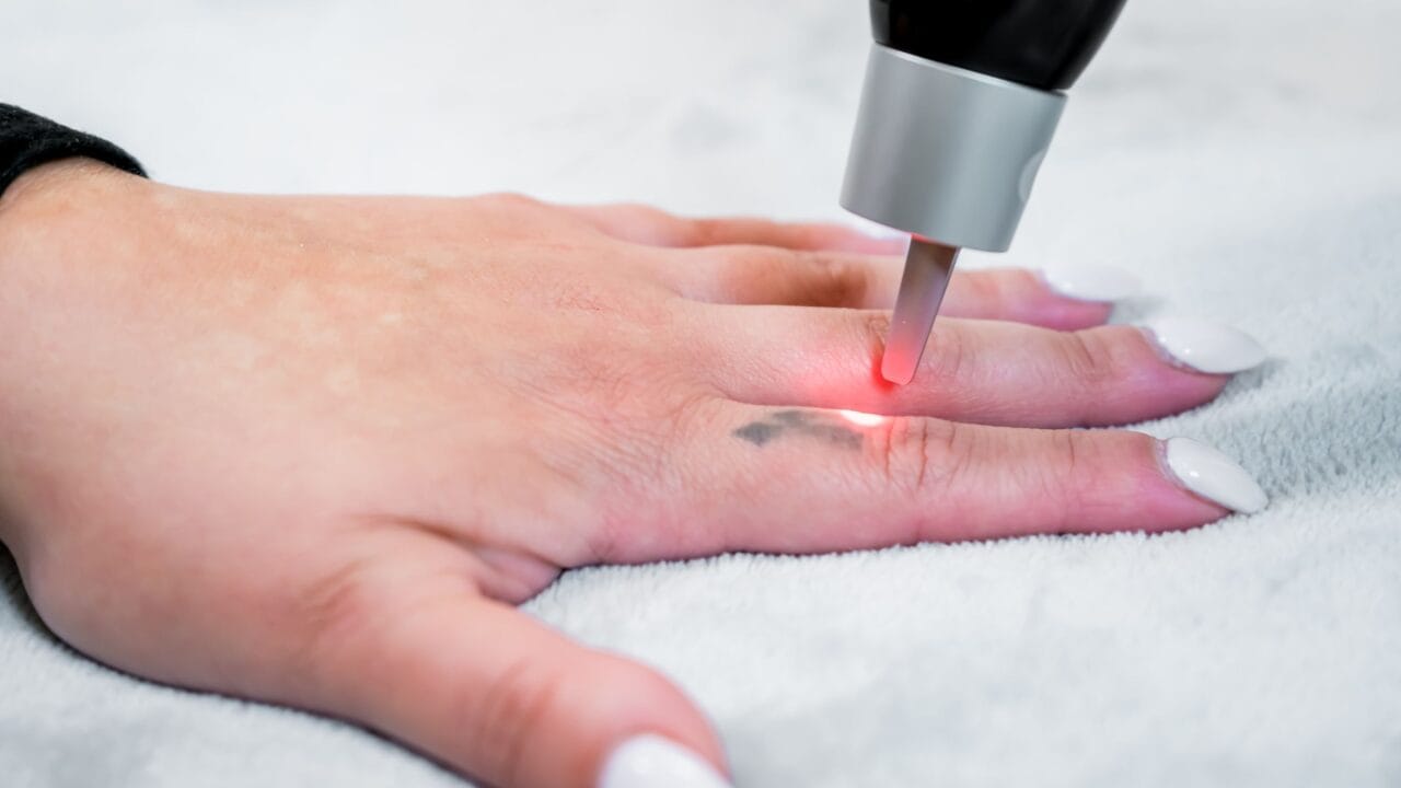 como funciona a remoção de tatuagem a laser e a fragmentação dos pigmentos