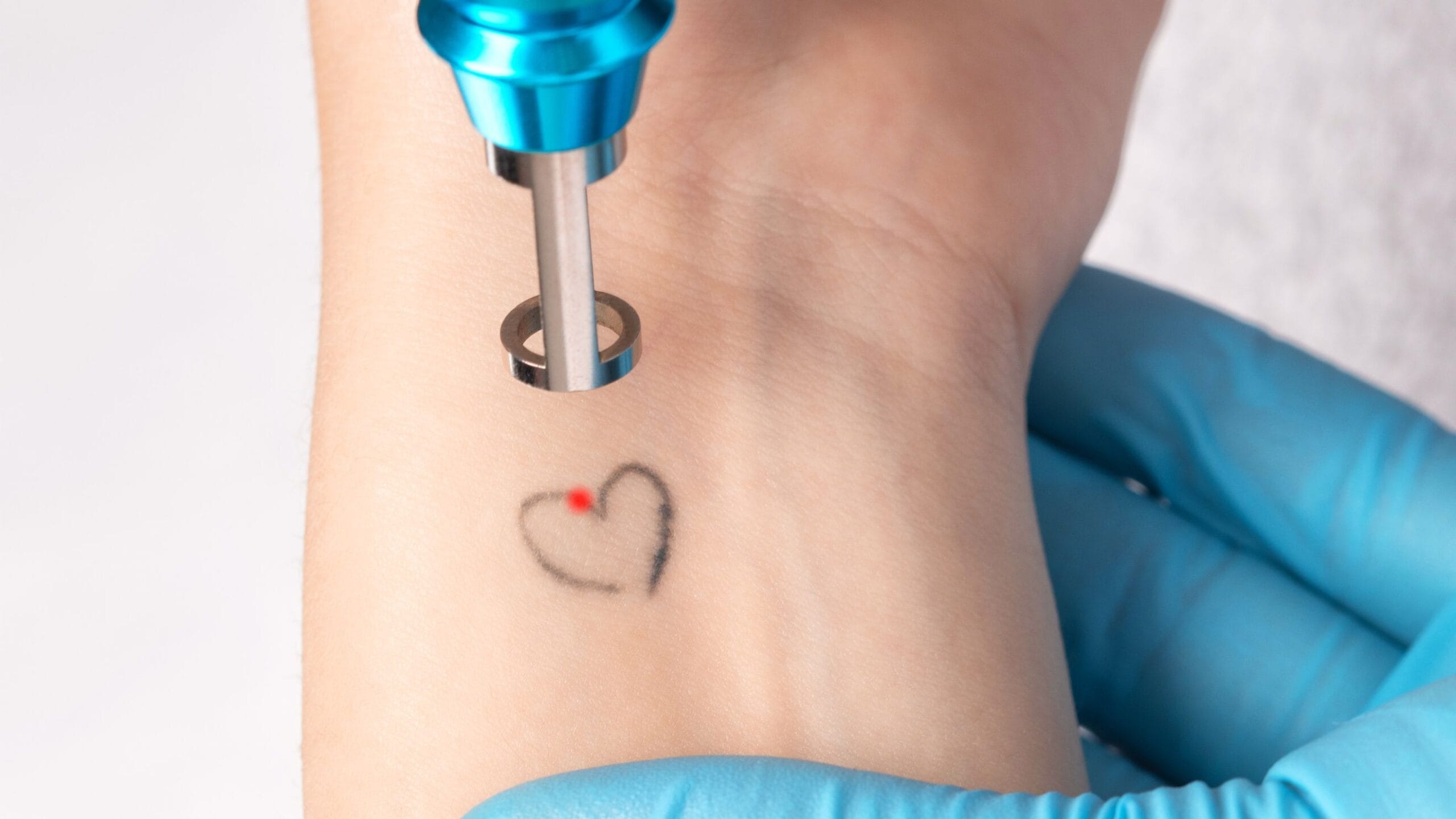 intervalo adequado entre sessões de remoção de tatuagem
