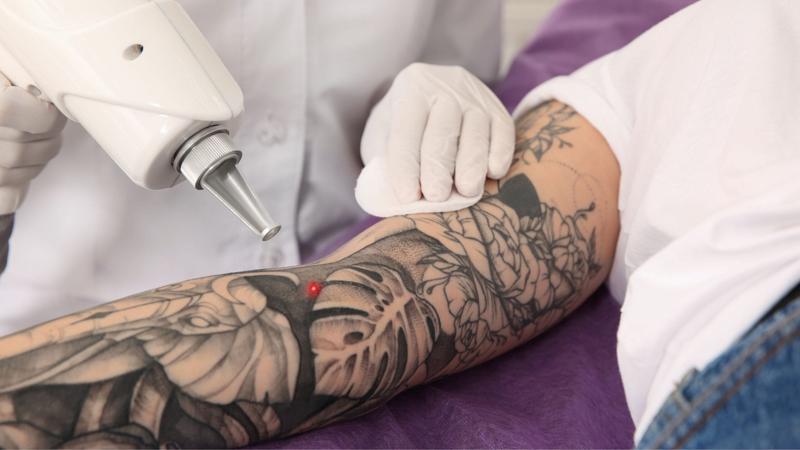 remoção de tatuagem de cobertura (cover-up) antes e durante o tratamento