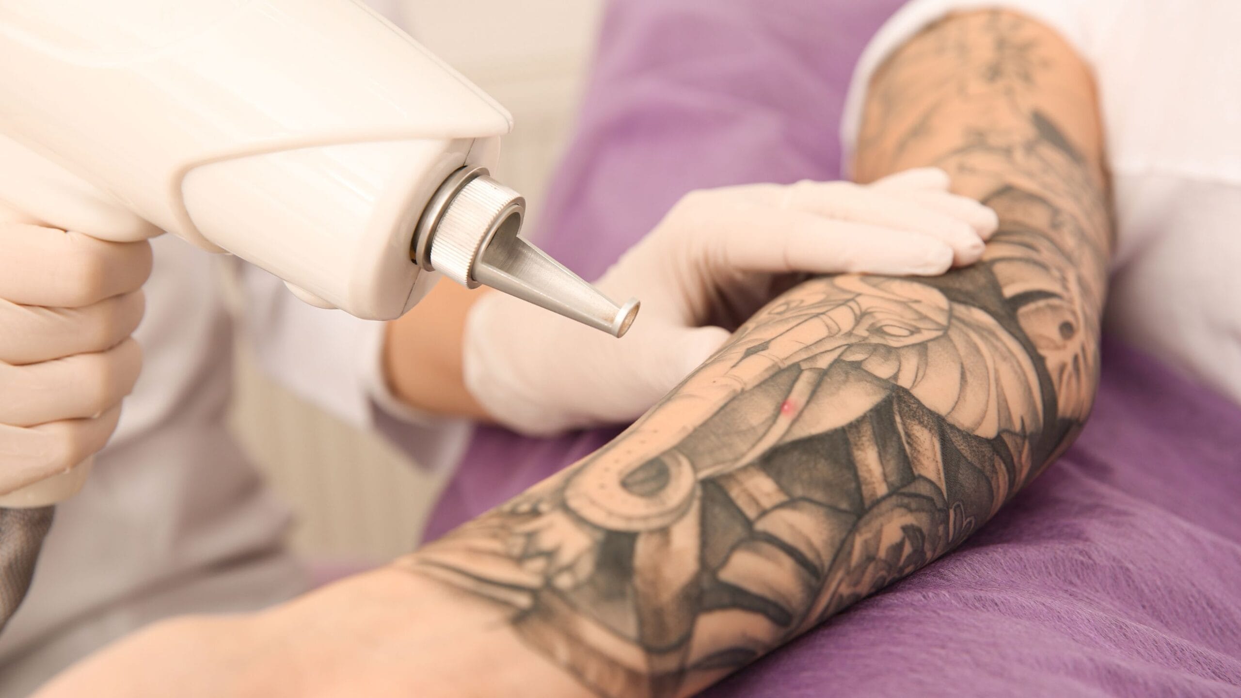 fatores que tornam uma tatuagem mais difícil de remover