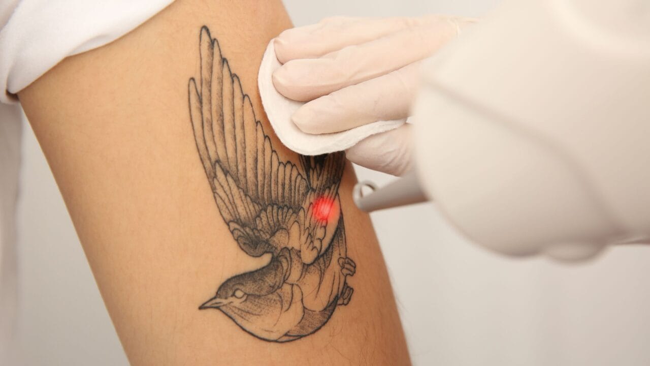 remoção de tatuagem recém-feita após cicatrização da pele