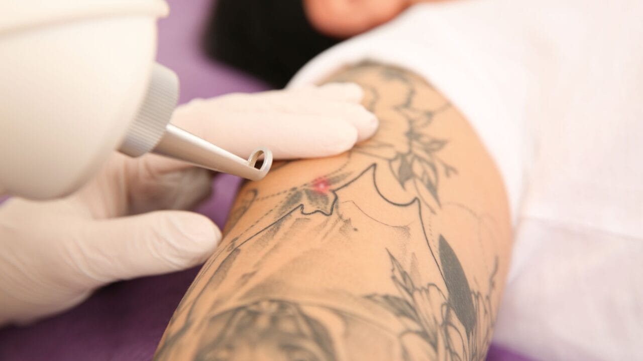 remoção de tatuagem e desconforto durante o tratamento
