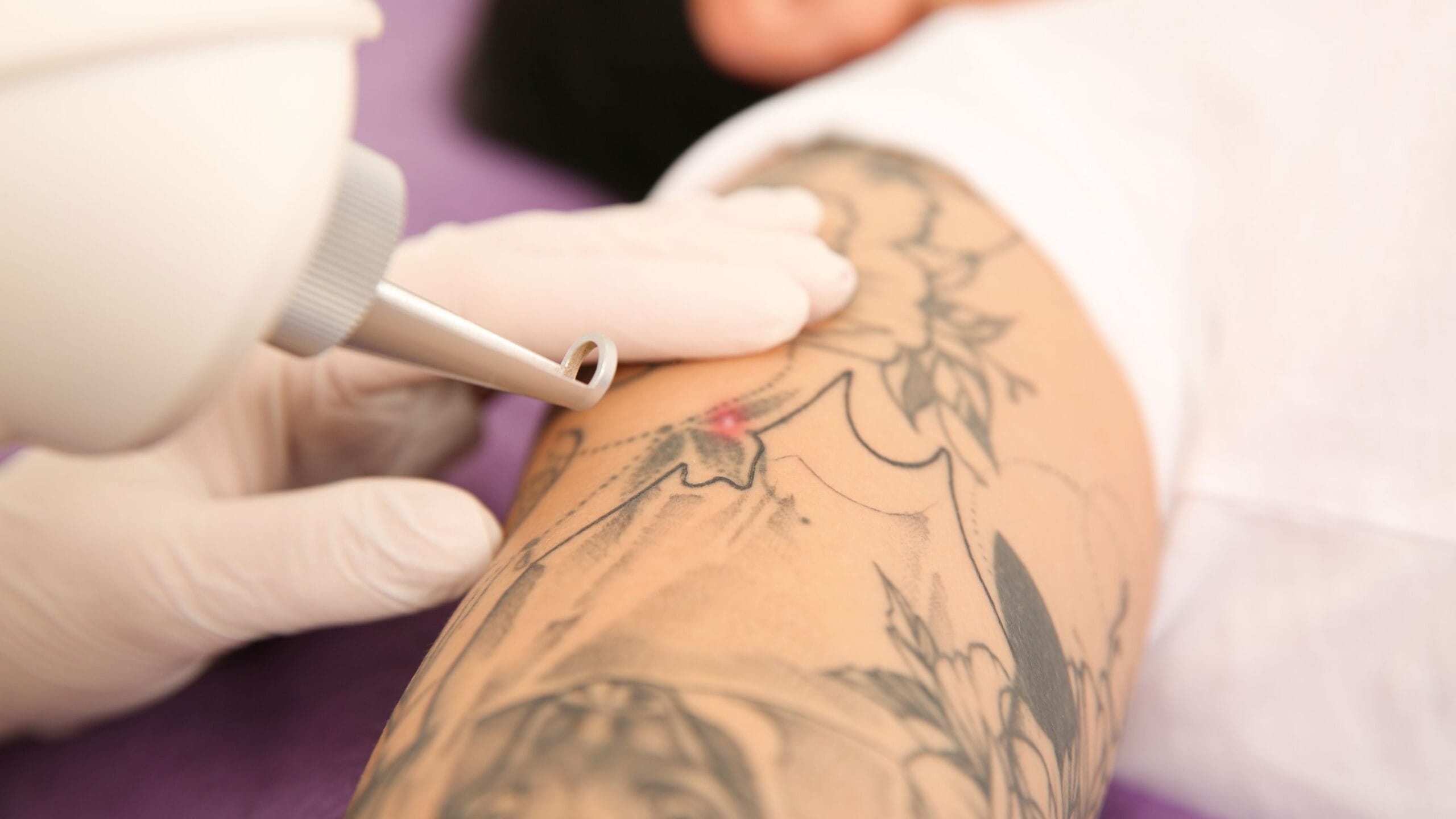 remoção de tatuagem e desconforto durante o tratamento
