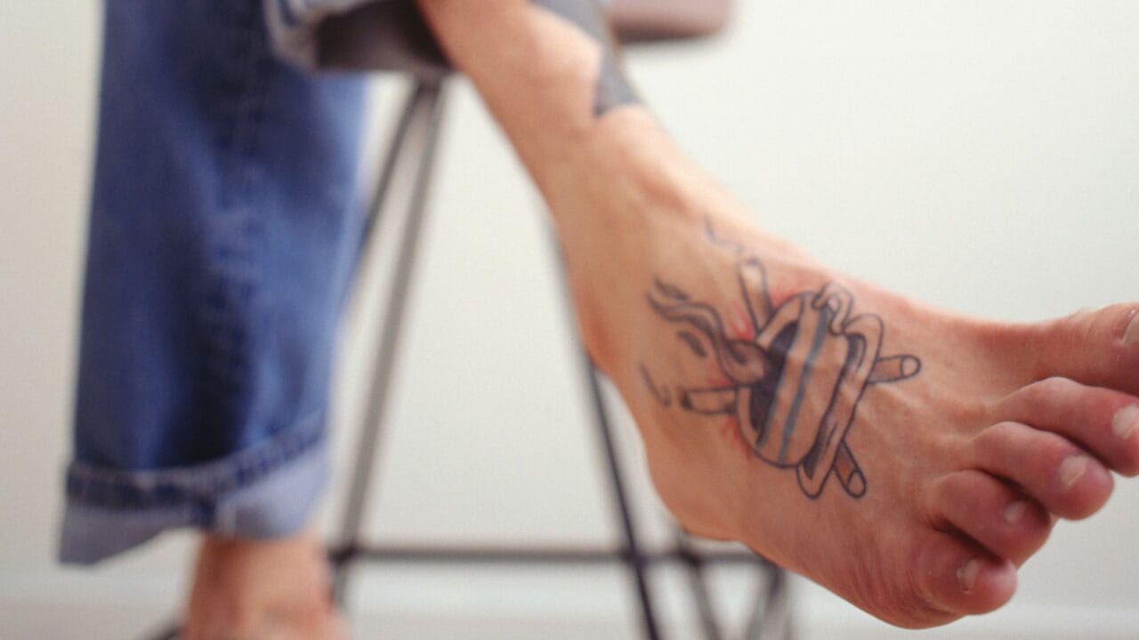remoção de tatuagem no pé durante tratamento dermatológico