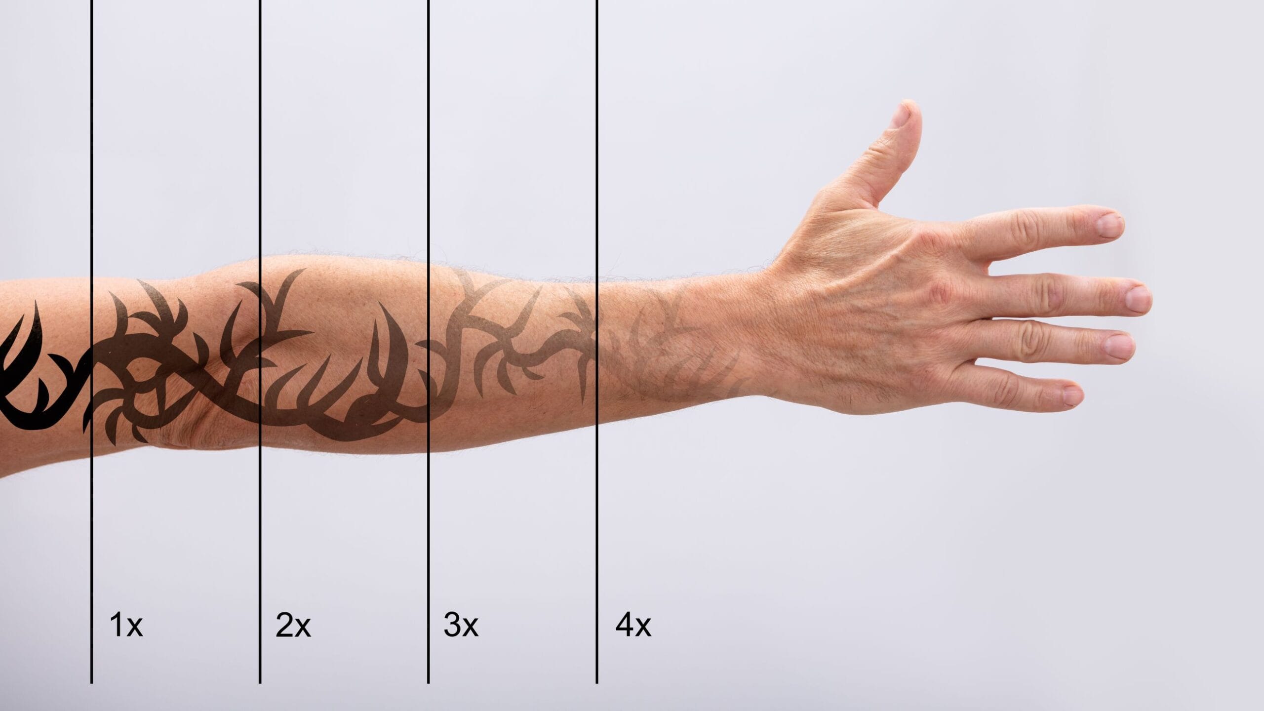fatores que influenciam o valor da remoção de tatuagem a laser